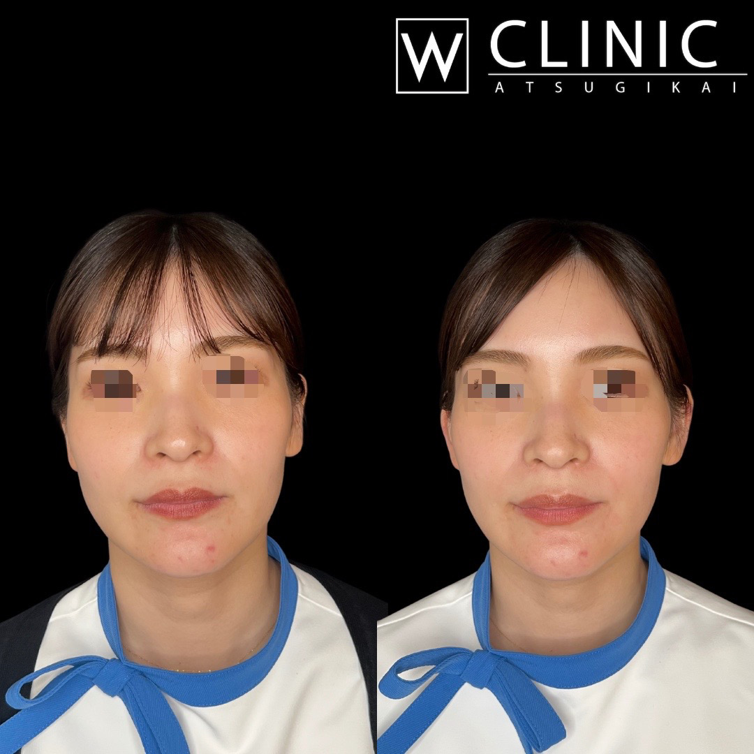 立ち耳ヒアルロン酸