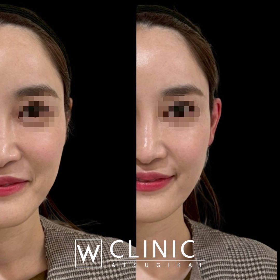 立ち耳ヒアルロン酸