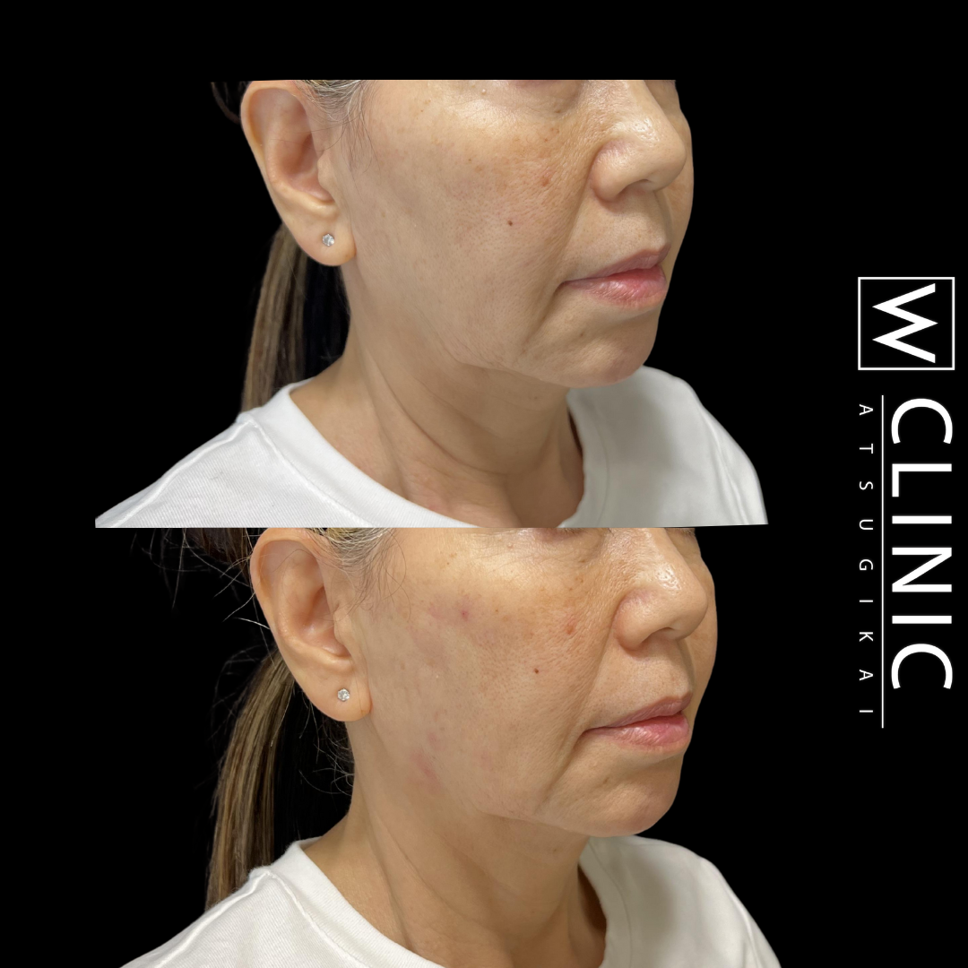 リフトアップヒアルロン酸 施術2週間後