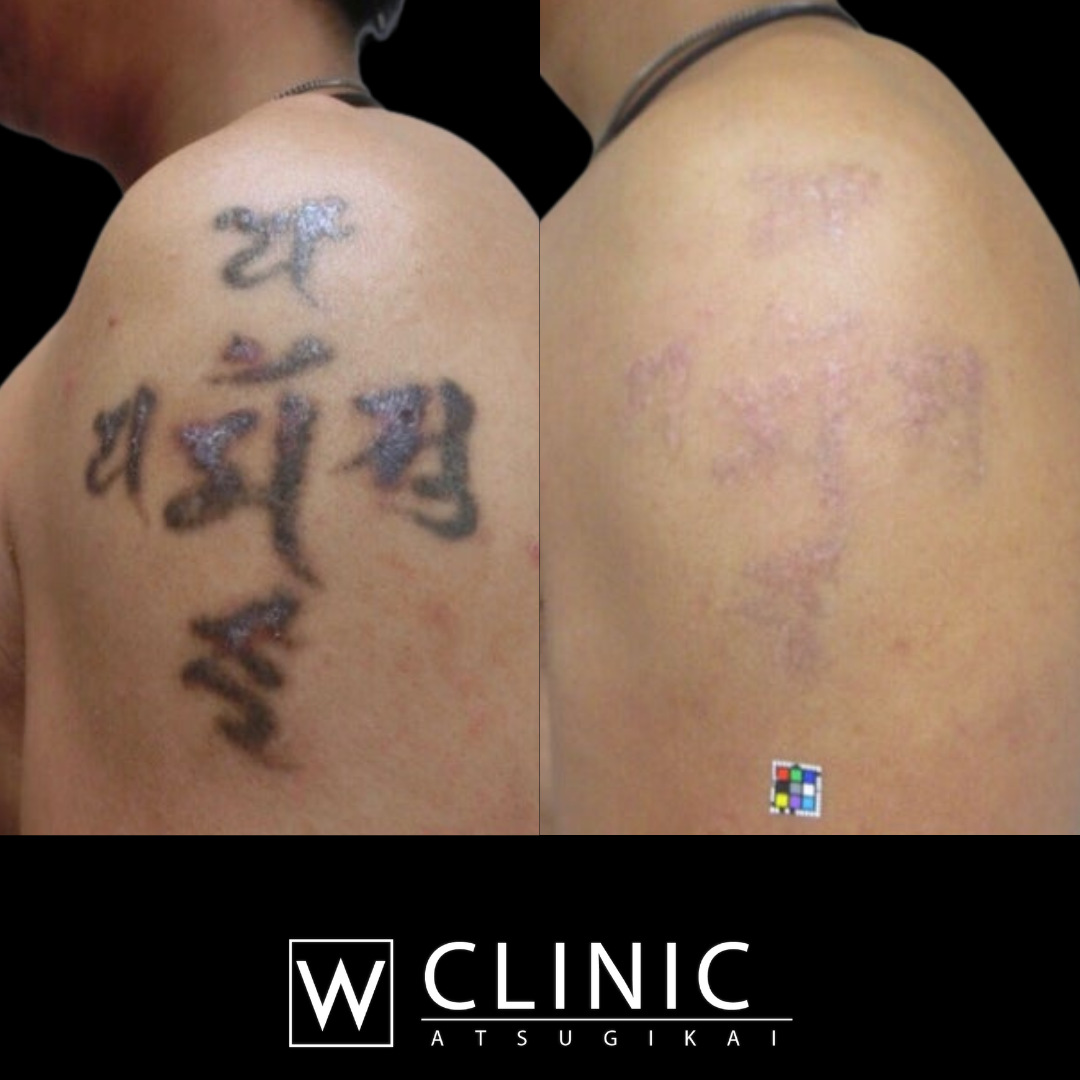 タトゥー除去