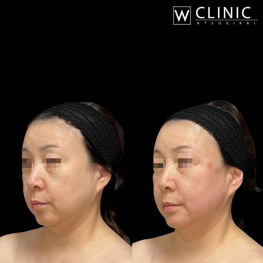 アッティバ 全顔 施術直後