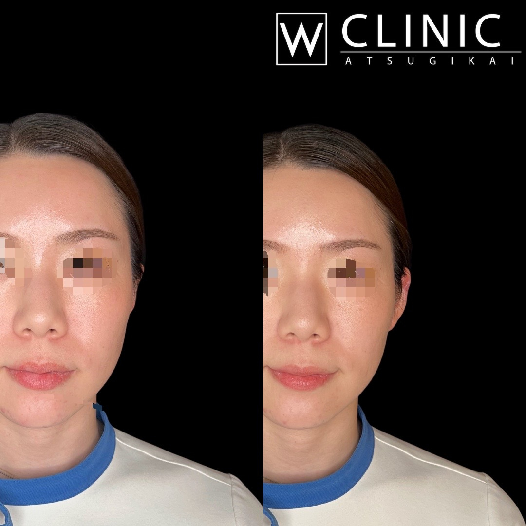 立ち耳ヒアルロン酸