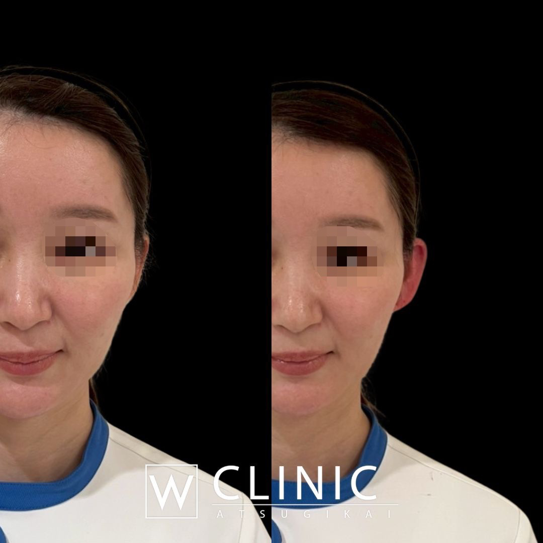 立ち耳ヒアルロン酸