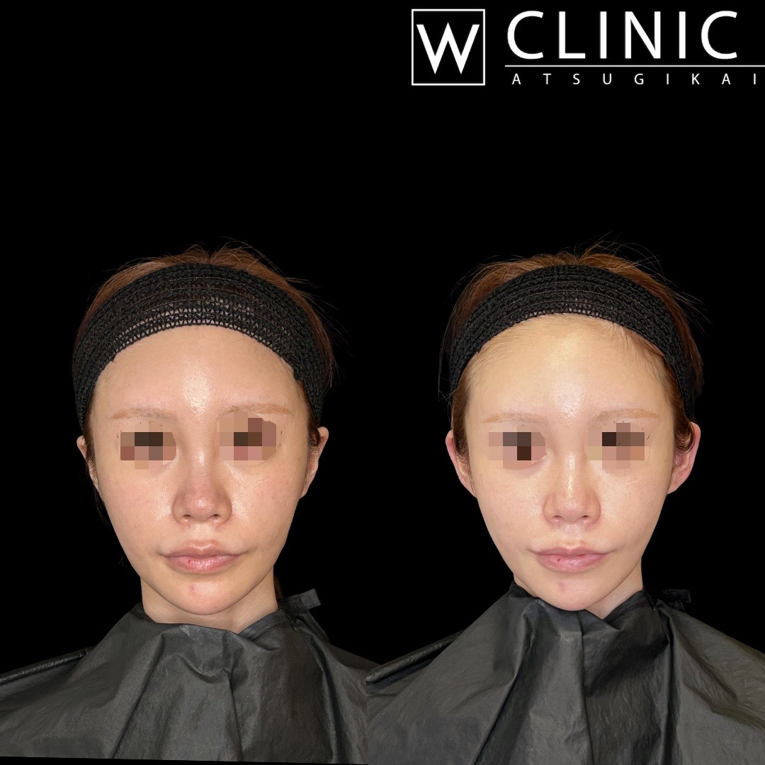 立ち耳ヒアルロン酸