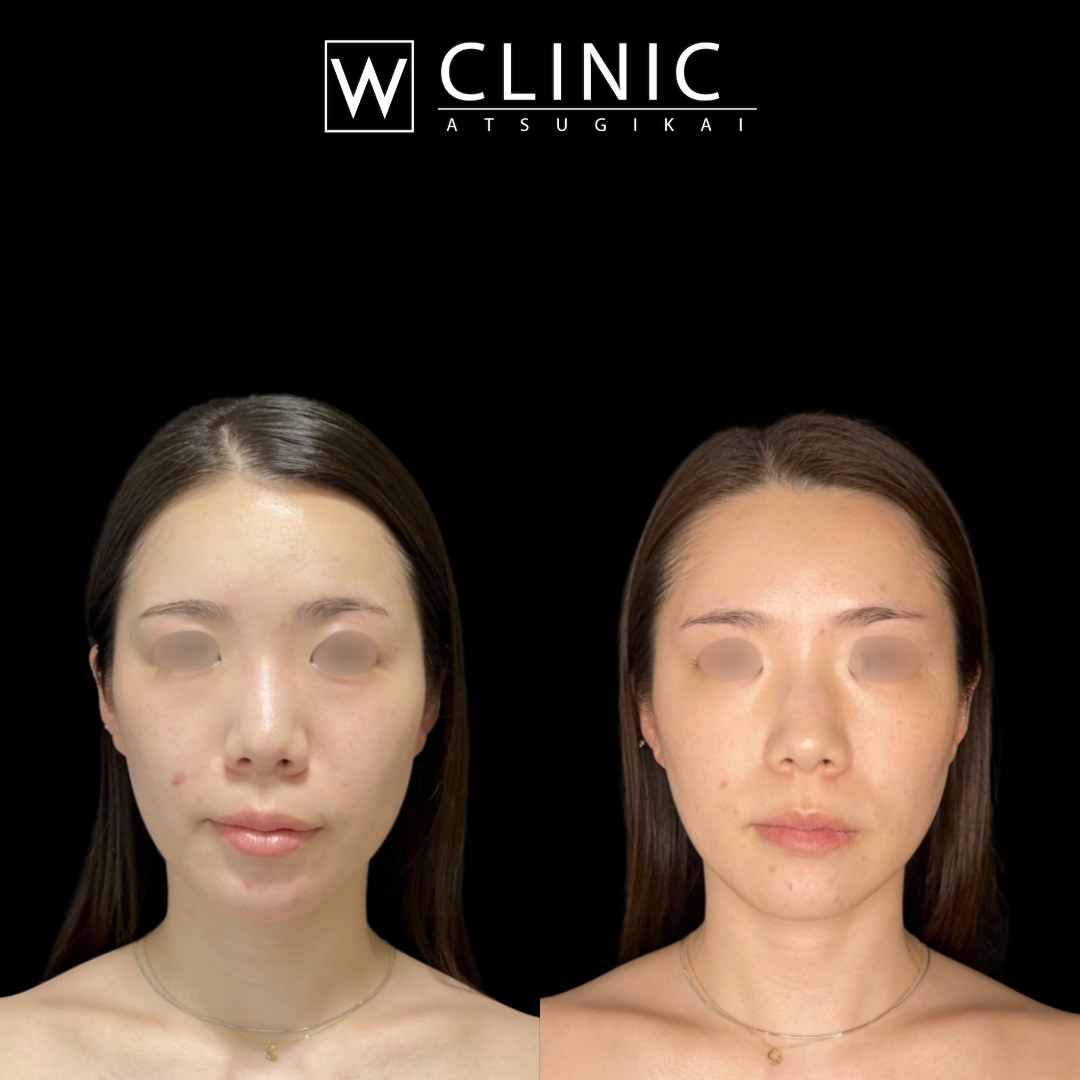 ビタミンリフト90本