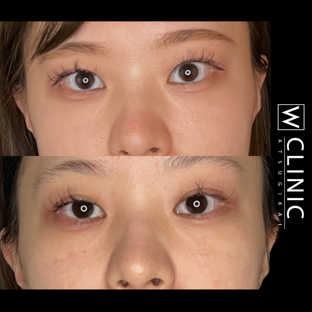 二重まぶた 埋没法 施術前