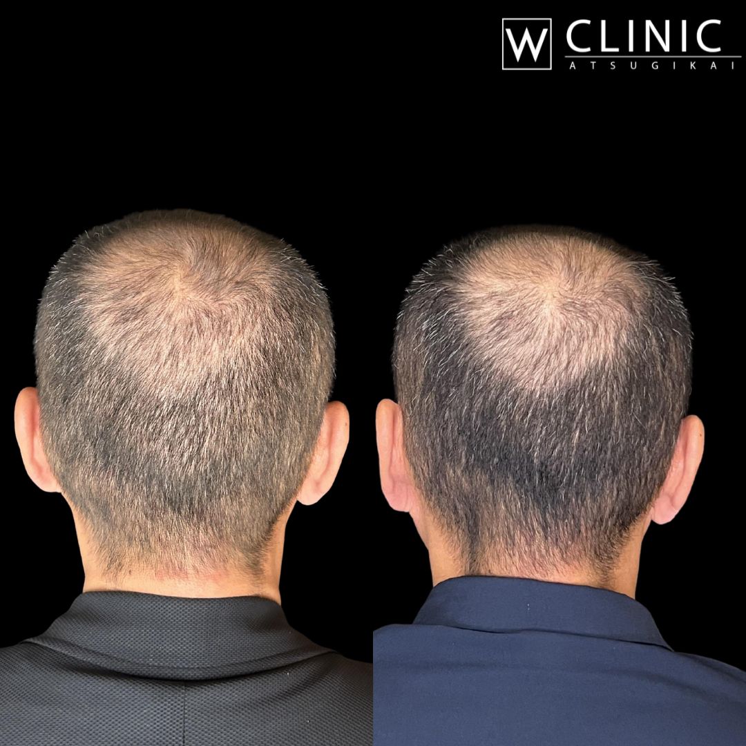 エクソソームカクテル注射