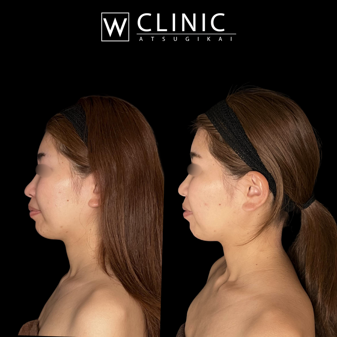 アッティバ 上瞼 施術直後