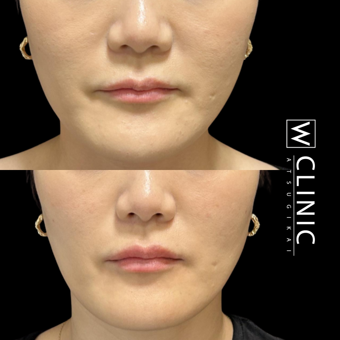 唇ヒアルロン酸 施術前