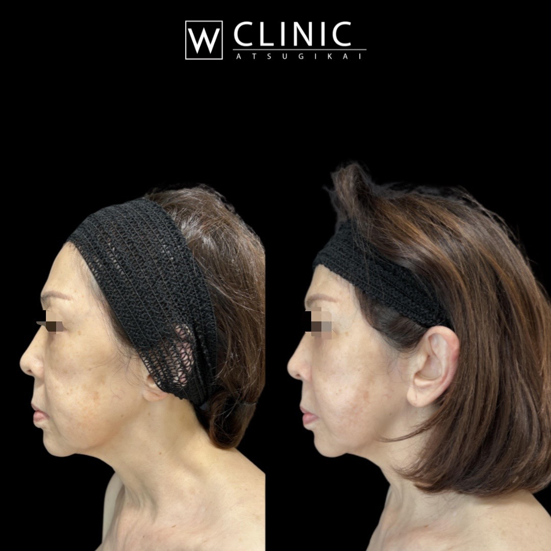 アルテミスリフト8本 施術2週間後