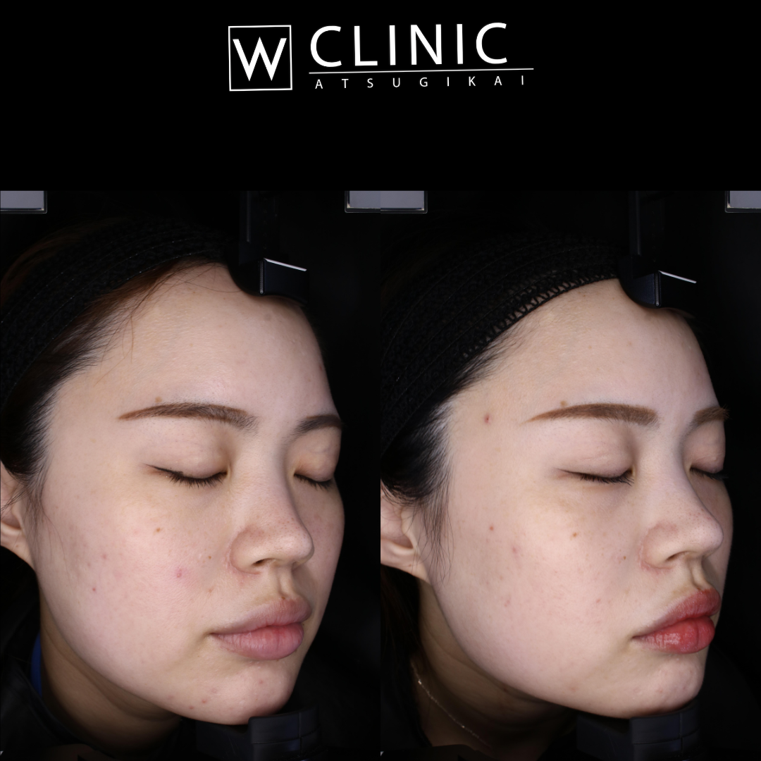 プルリアル 施術1ヶ月後