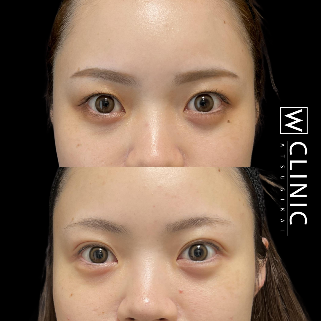 二重まぶた 埋没法 施術1ヶ月後