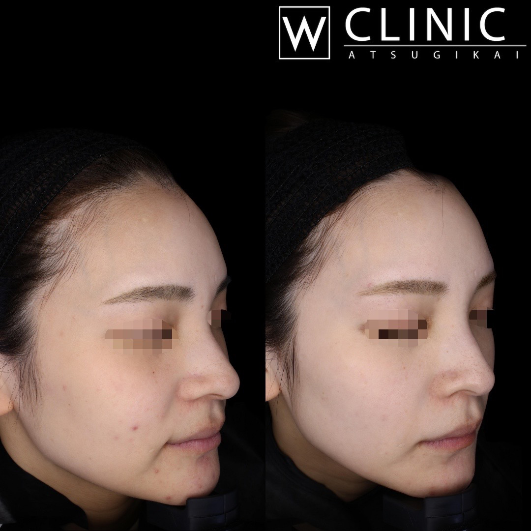 プルリアル 施術1ヶ月後