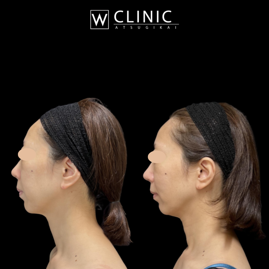 プレコラ10本 施術2週間後