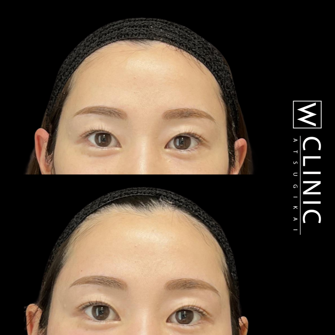 二重まぶた 埋没法 施術1ヶ月後