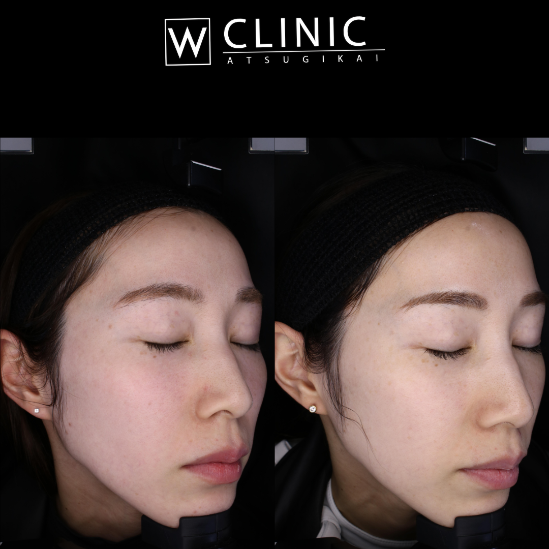 プルリアル 施術前