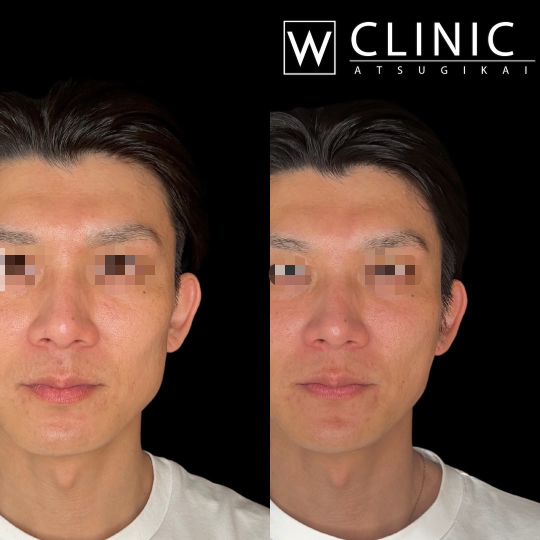 ヒアルロン酸・ボトックス 施術前