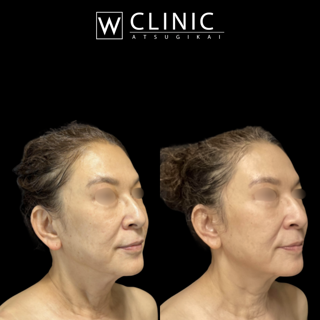 アッティバ 上瞼 施術直後