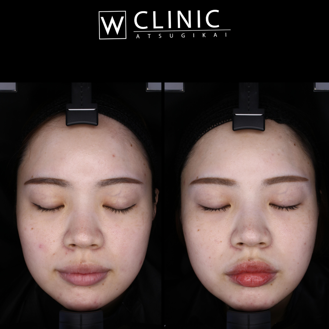 プルリアル 施術前