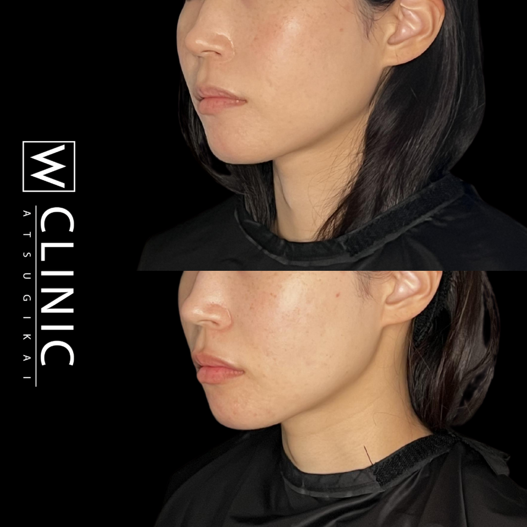 唇ヒアルロン酸 施術直後