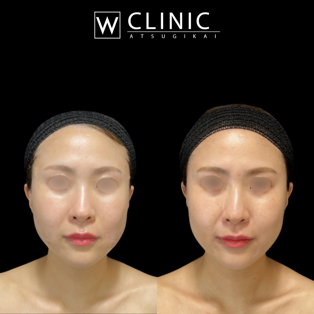 アルテミスロング10本+ショート4本