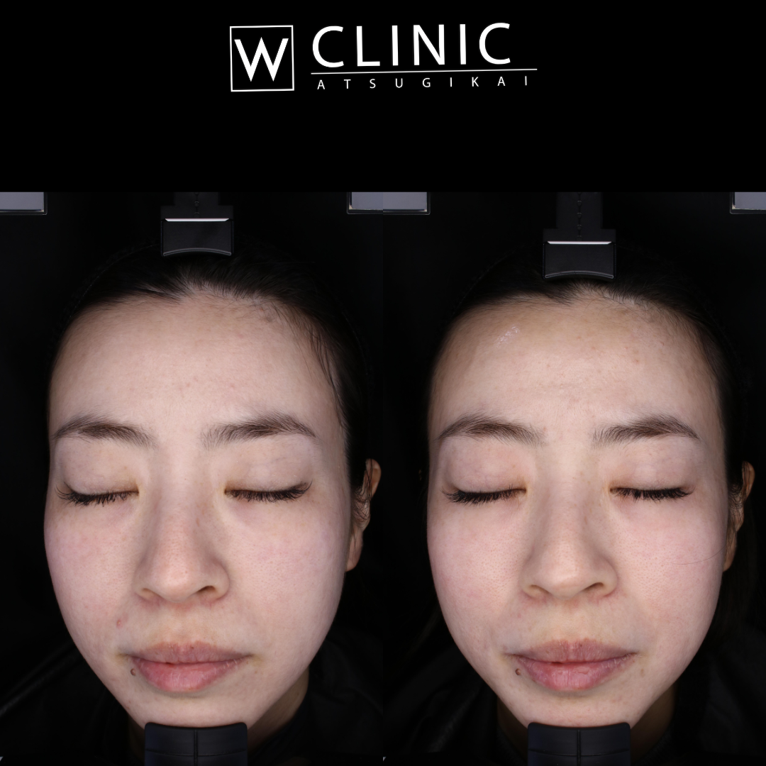 プルリアル 施術1ヶ月後