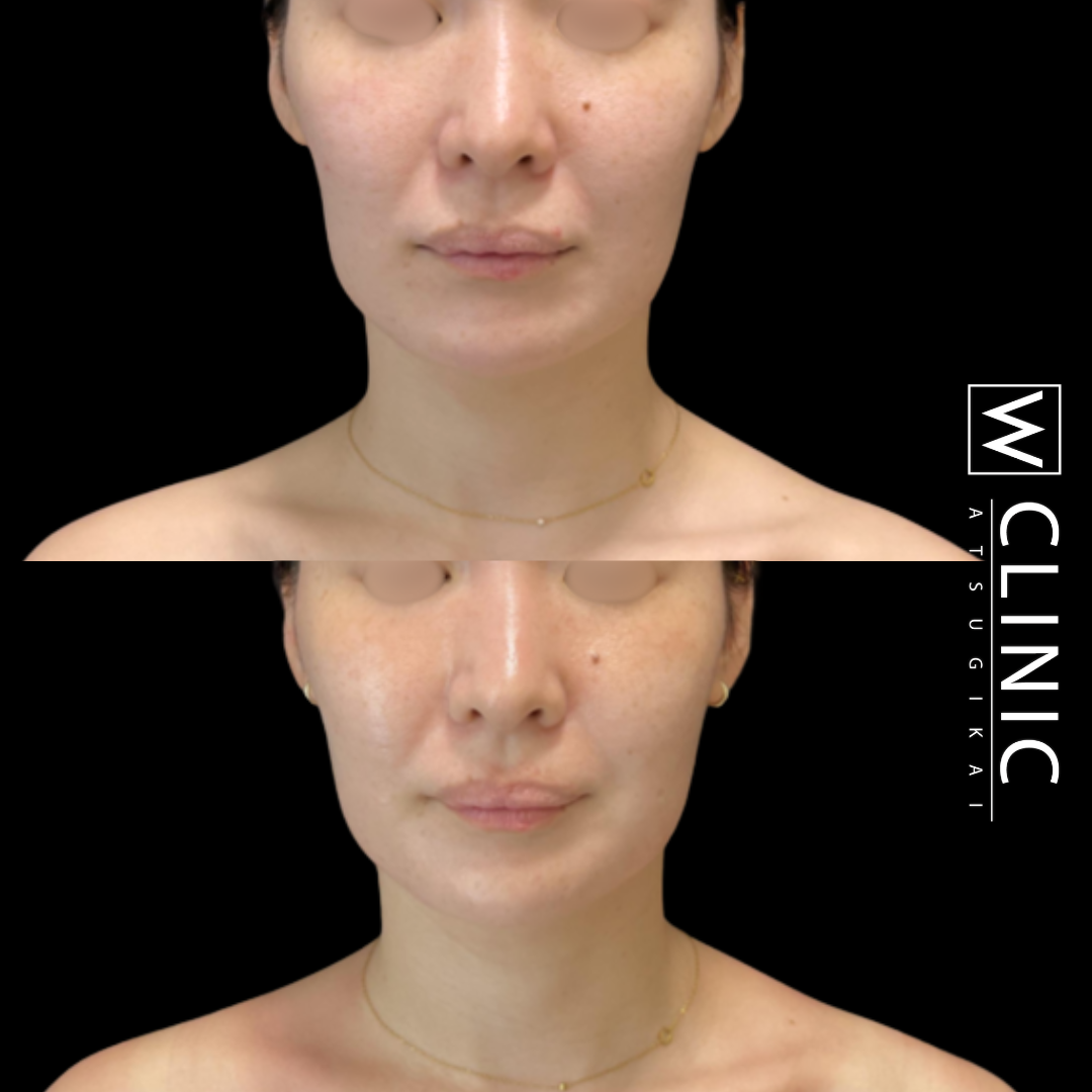 ヒアルロン酸注入