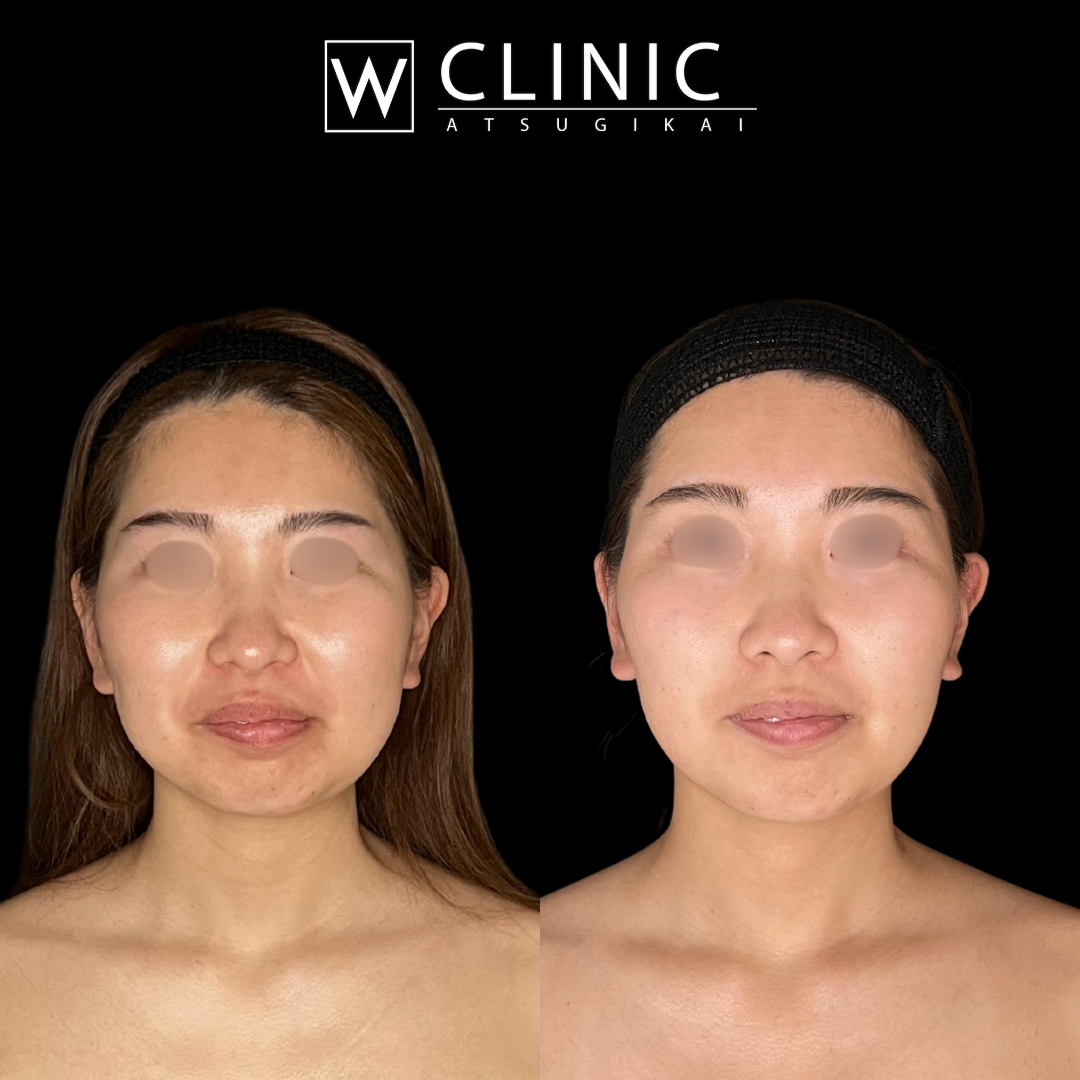 アッティバ 上瞼 施術前