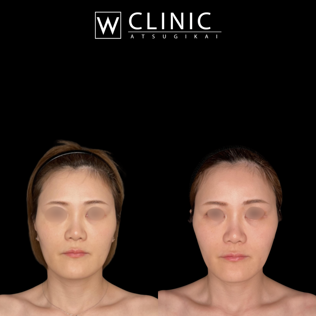 アルテミスリフト12本