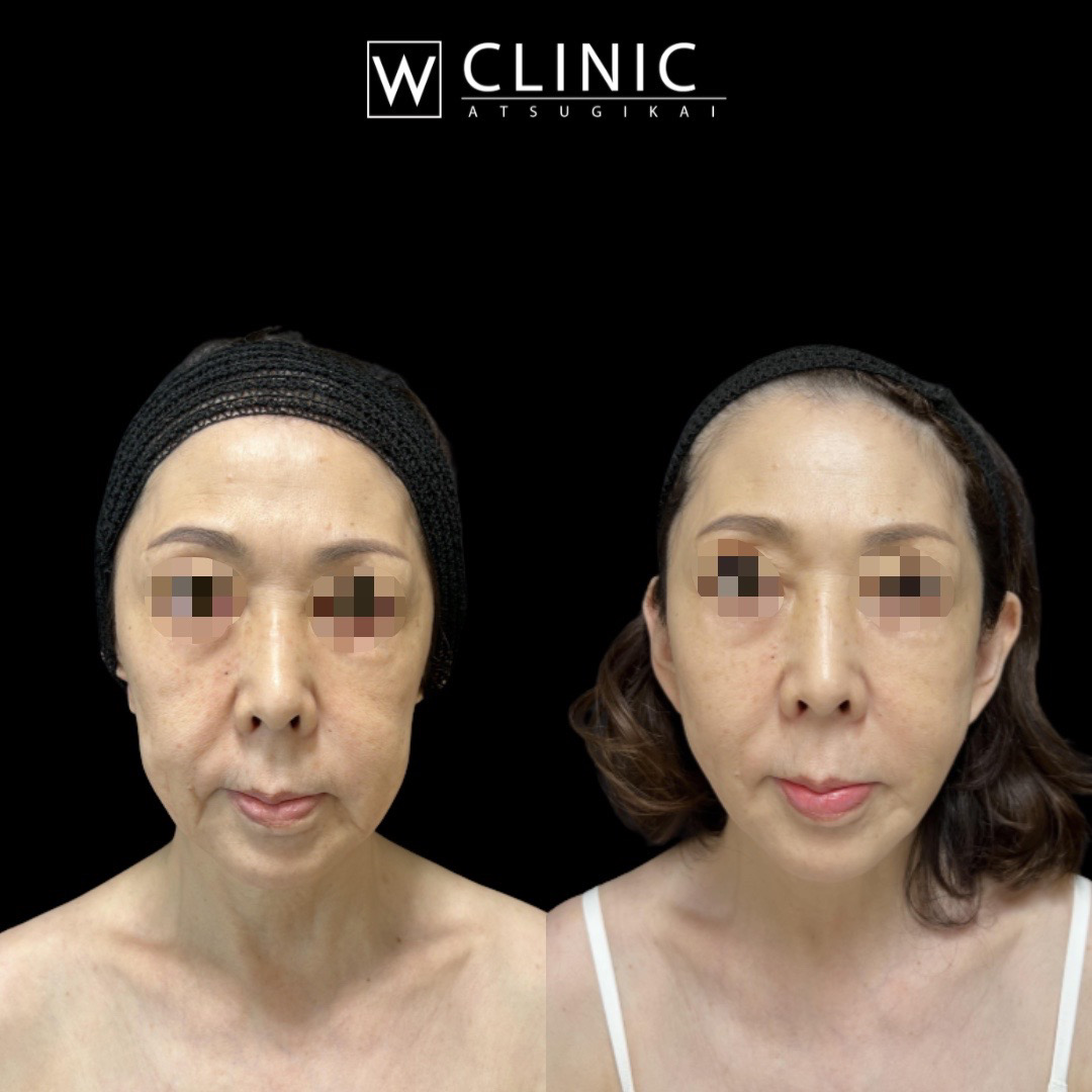 アルテミスリフト8本 施術前