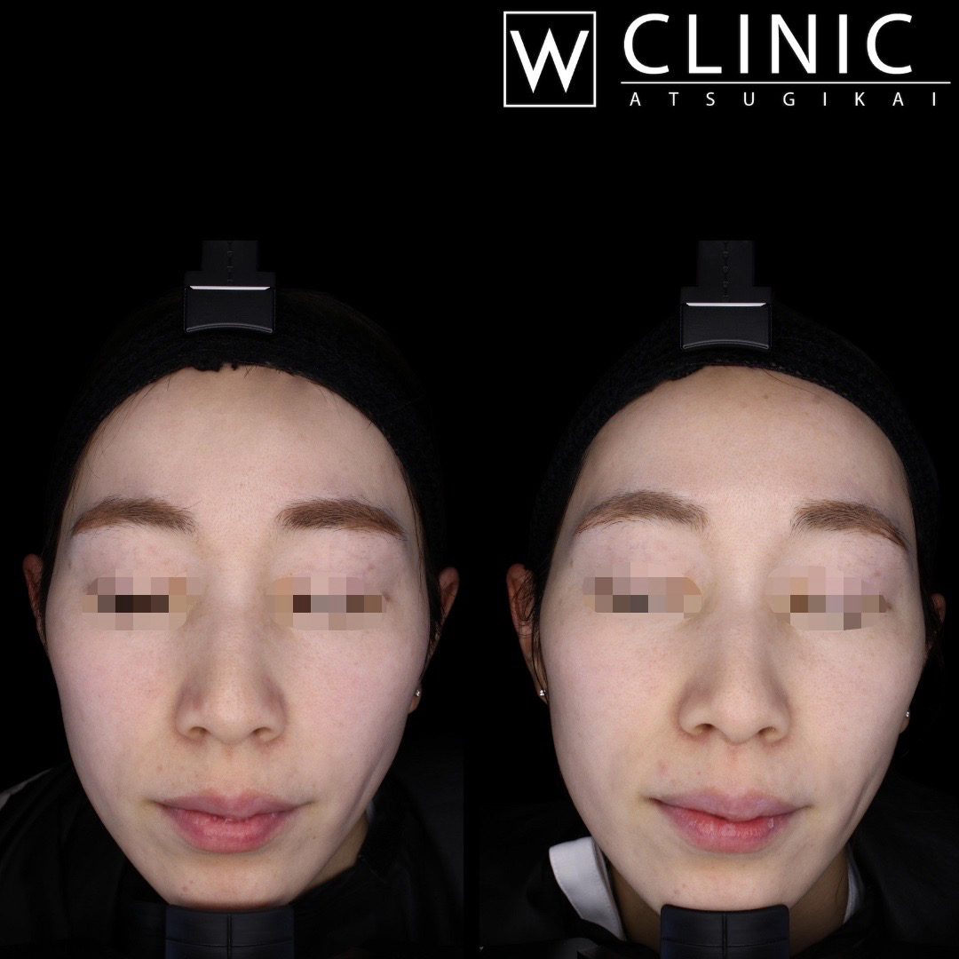 プルリアル 施術前