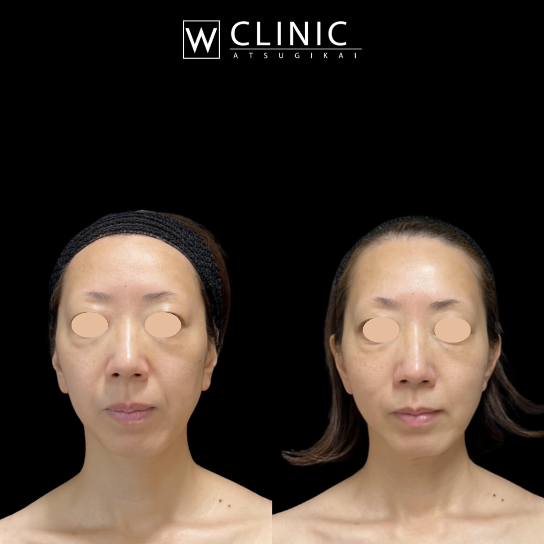 プレコラ10本 施術前