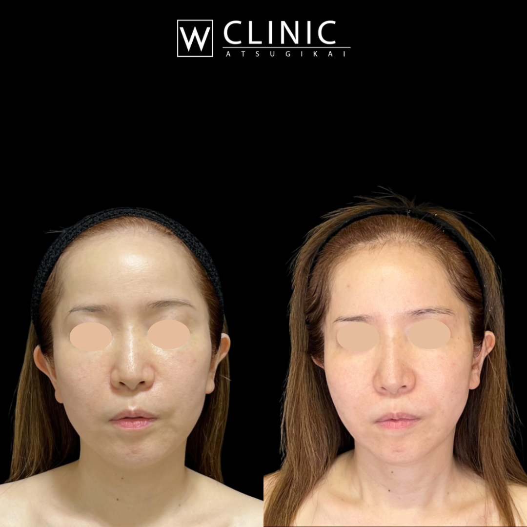 プレコラ10本 施術前