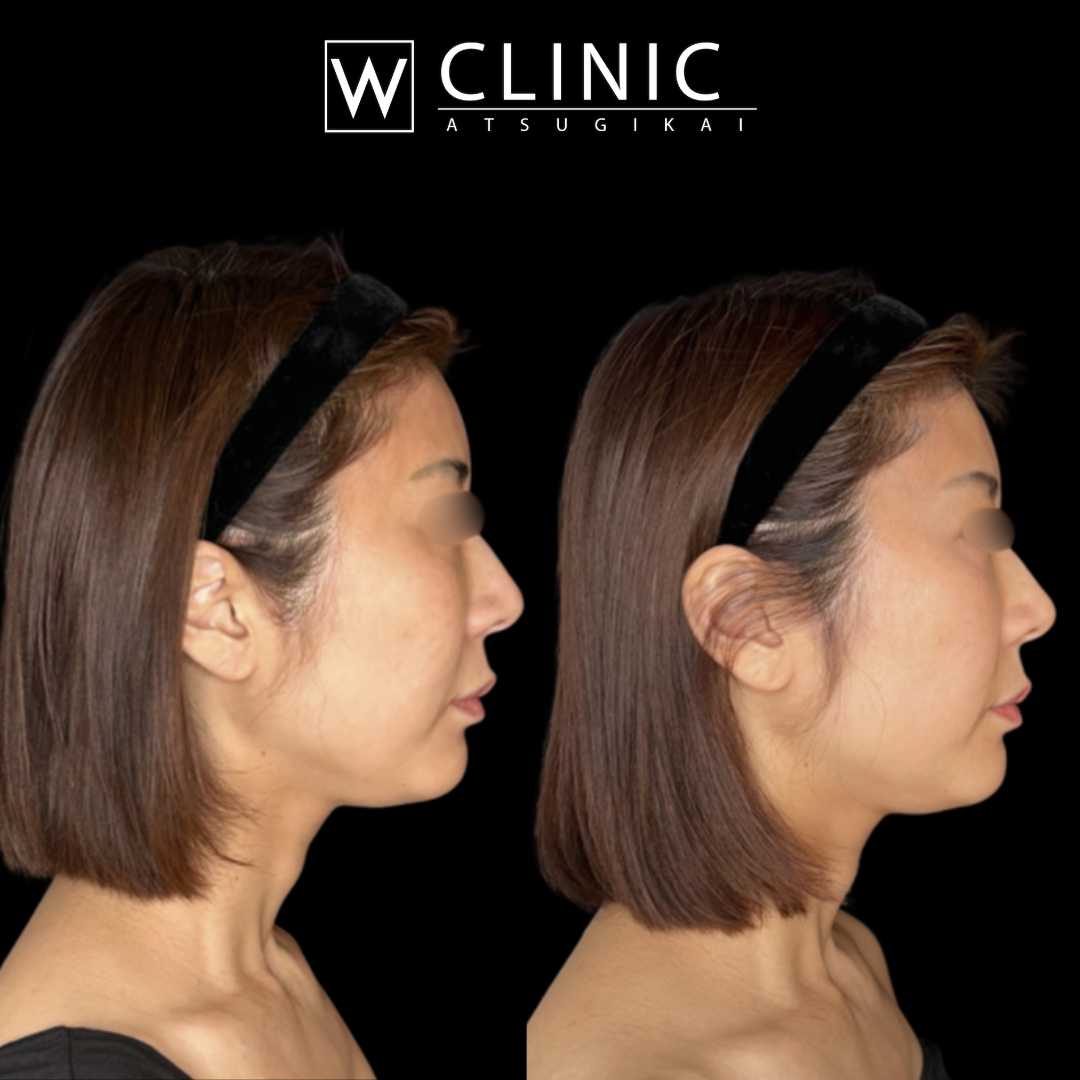 アッティバ 上瞼 施術直後