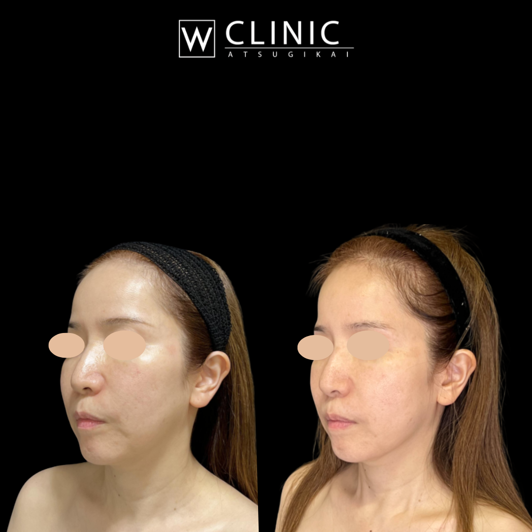 プレコラ10本 施術2週間後