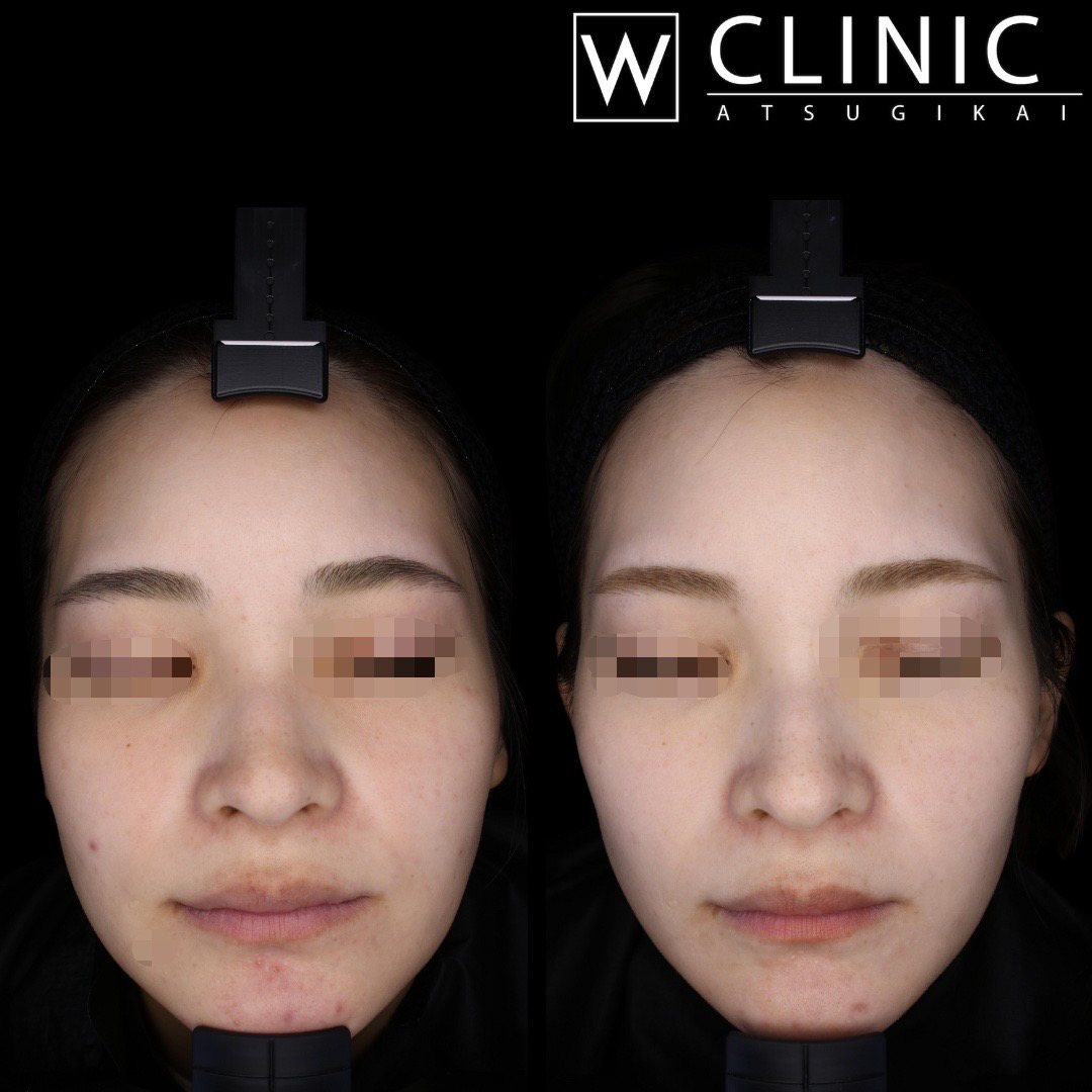 プルリアル 施術前