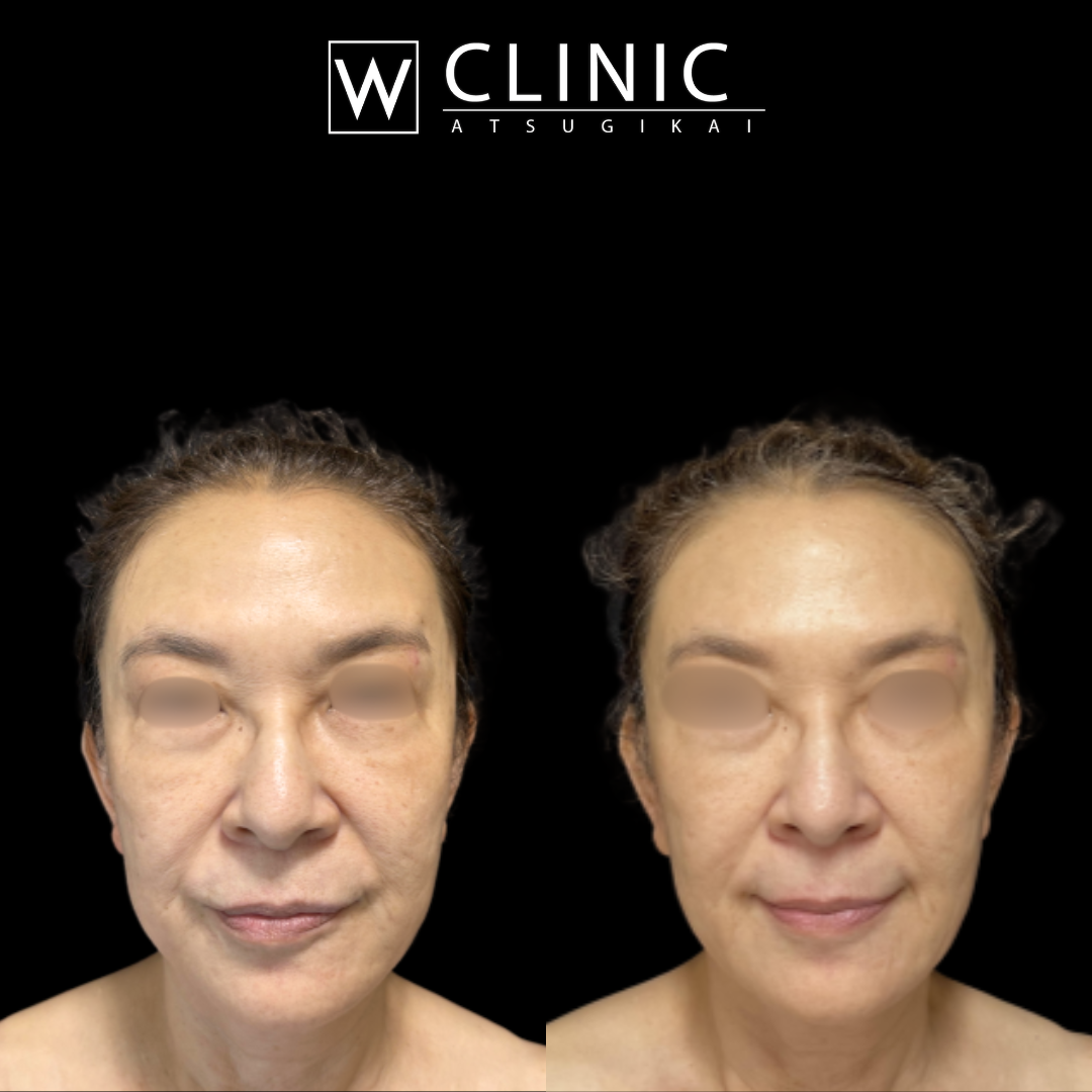 アッティバ 上瞼 施術前