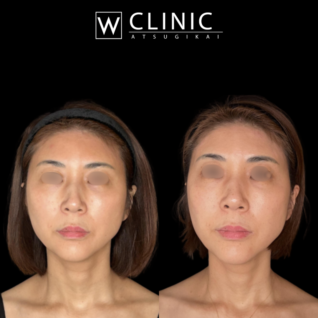 アッティバ 上瞼 施術前
