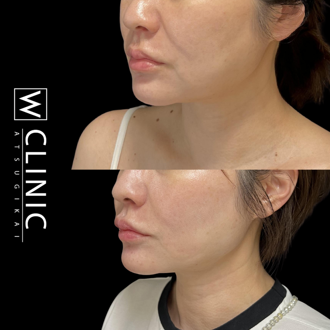 唇ヒアルロン酸 施術直後