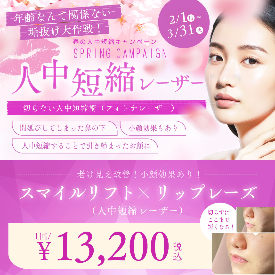 花粉症ボトックス